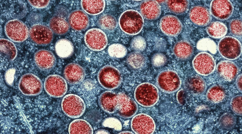 The Mpox virus uses a &lsquo;genomic accordion&rsquo; to evolve and infect humans (GS Paper 2, Issues relating to the development and management of Social Sector/Services)